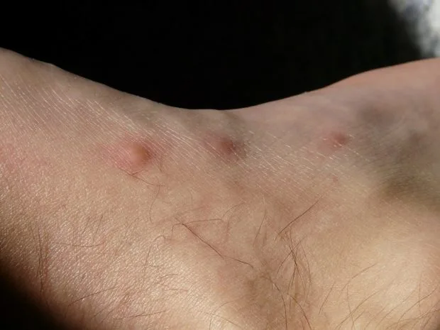 Kousnutí štěnic na lidské kůži s červenými pupínky.