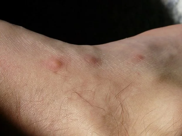 Kousnutí postelových blech na lidské kůži.