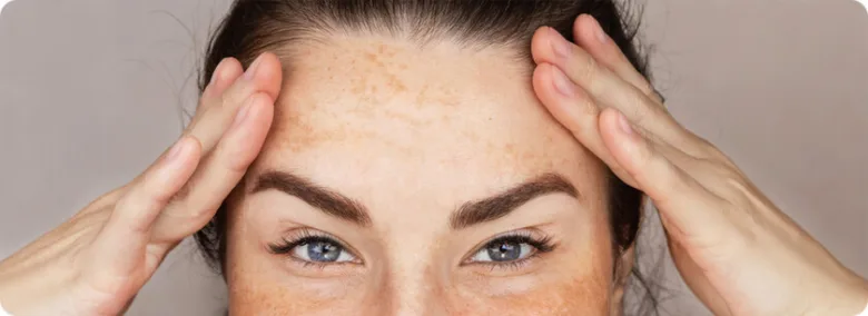 Woman with facial pigmentation