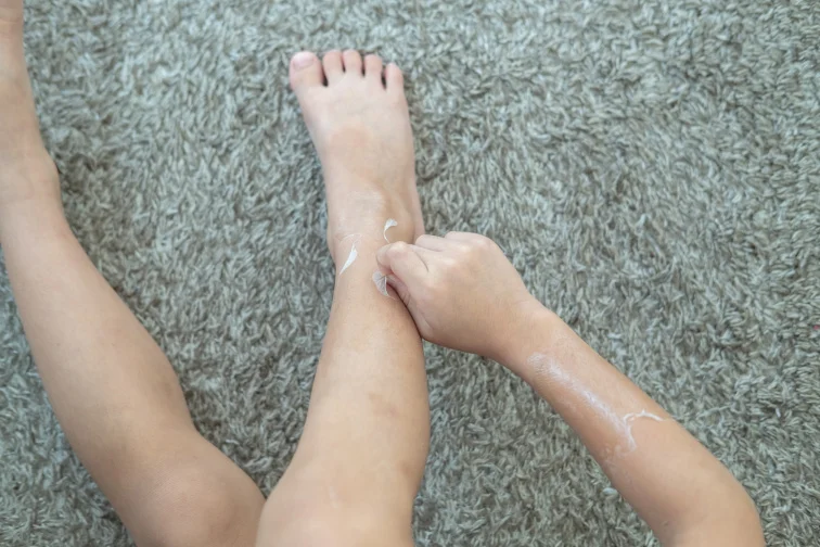 Osoba nanáší krém na suchou kůži nohou.